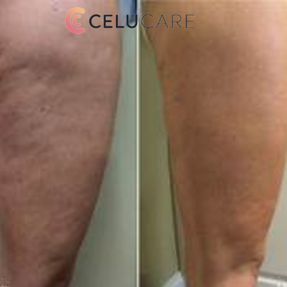 Nuevo masajeador anticelulítico Celucare®