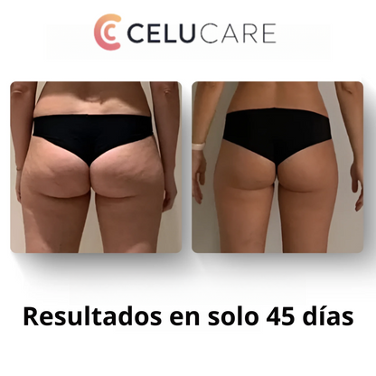 Nuevo masajeador anticelulítico Celucare®